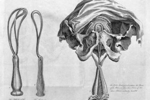 Obstetrical forceps 1773 from a lecture introductory to the theory and practice of midwiferyby john leake edit